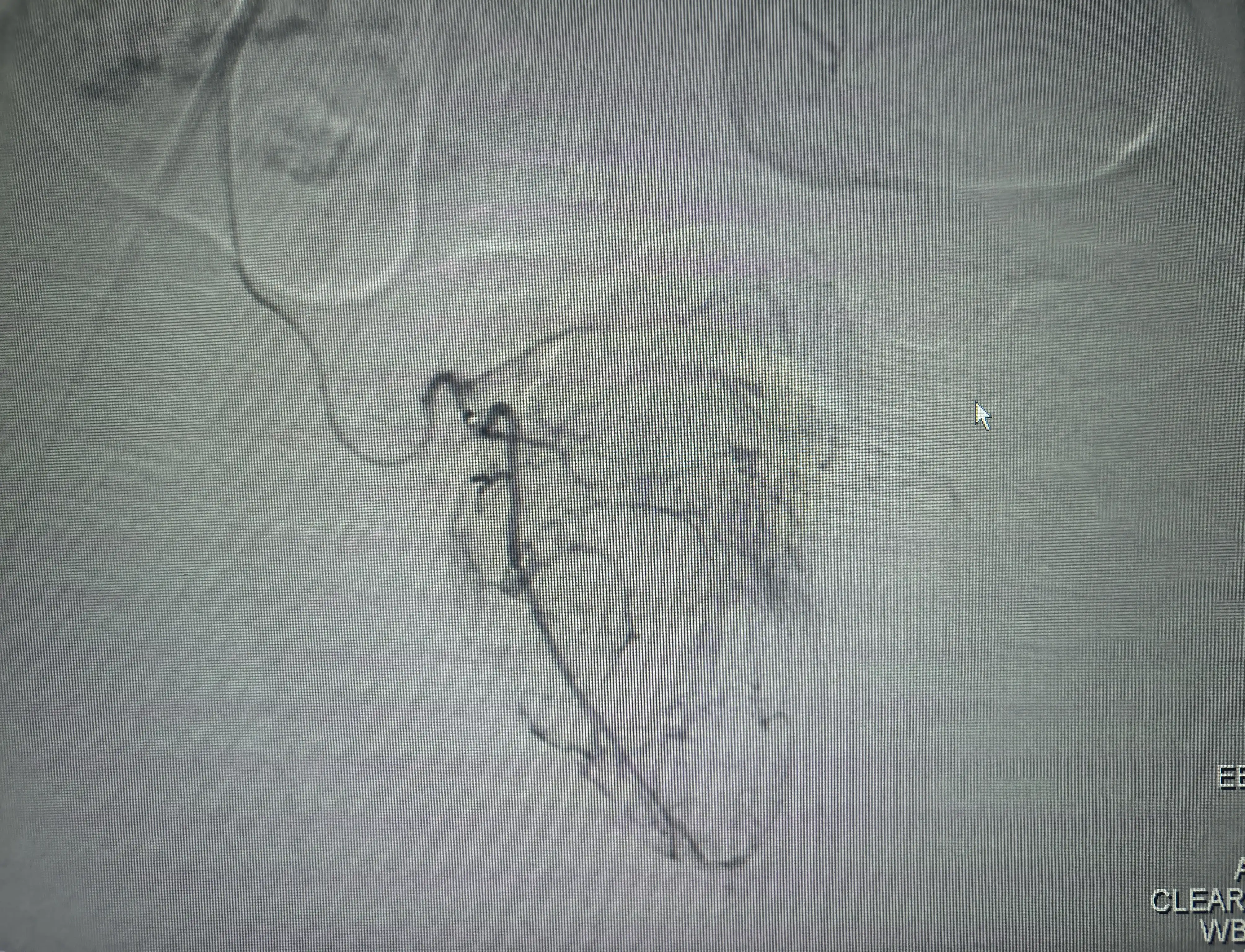 Right Prostatic Artery